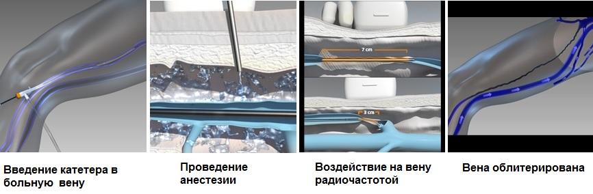 Этапы проведения радиочастотной облитерации (РЧО) вен