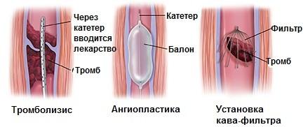 Хирургические методы лечения тромбоза глубоких вен
