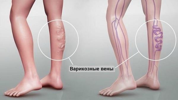 Результат лечения рецидива варикозной болезни лазером