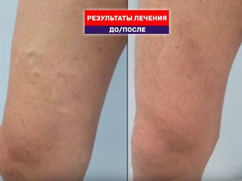 Из операционной — на танцпол. Отзыв о результате тотал ЭВЛК через 3 месяца после операции