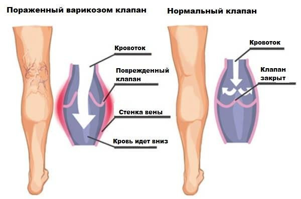 ХВН - хроническая венозная недостаточность нижних конечностей