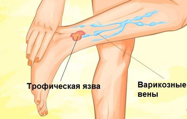 Трофическая язва. Причины, симптомы, диагностика и лечение венозной трофической язвы