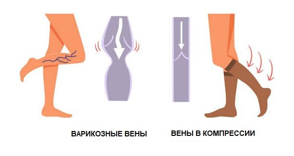 Компрессионный трикотаж избавляет от варикоза. Почему флебологи назначают компрессионный трикотаж.