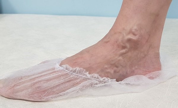 Варикозное расширение вен на стопах. Причины, симптомы, диагностика и лечение варикоза стопы.