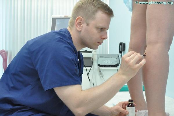 Калачев И.И. проводит разметку перед операцией ЭВЛК