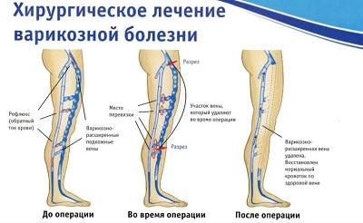 Этапы проведения классической флебэктомии